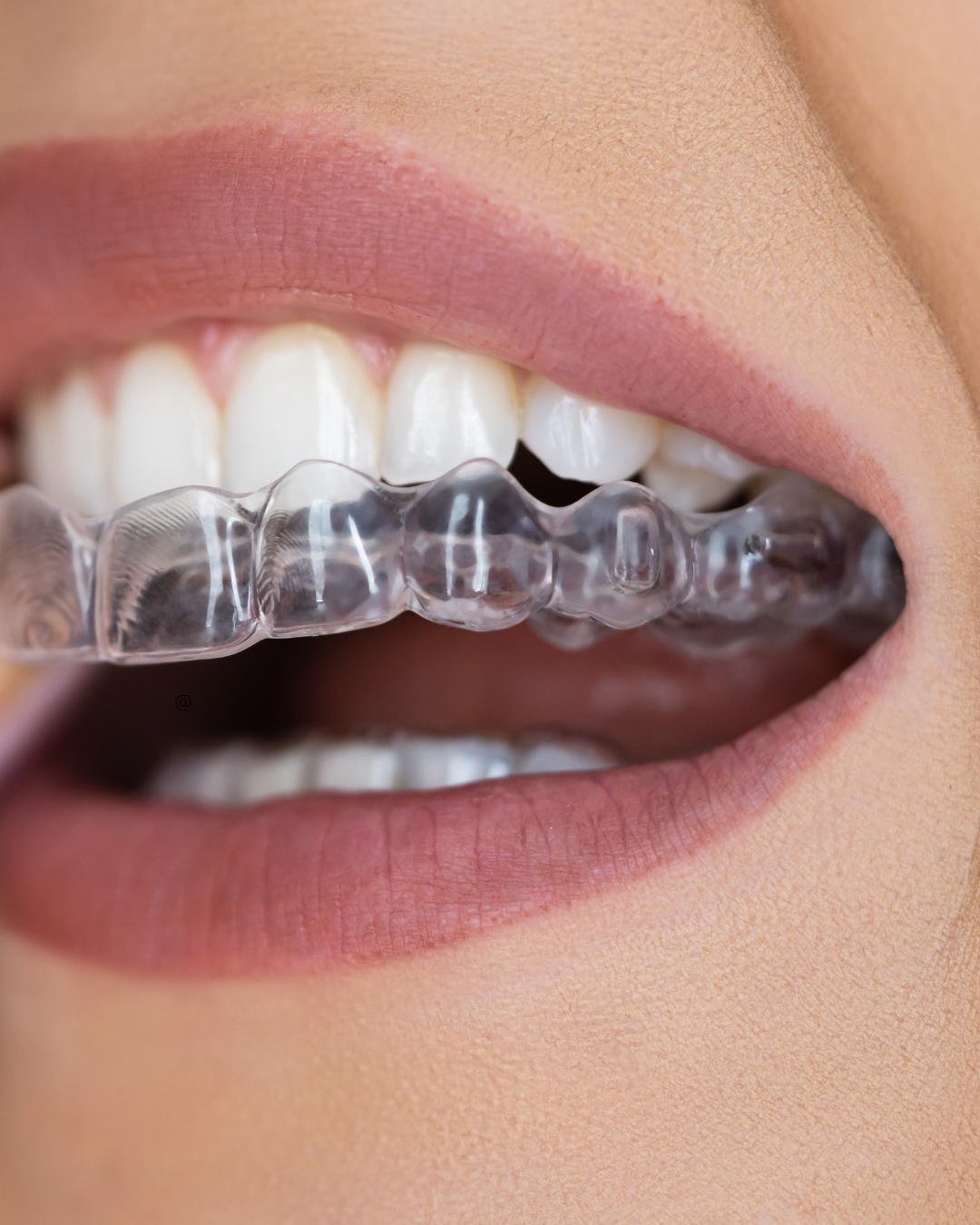 Clear dental aligner held in front of teeth
